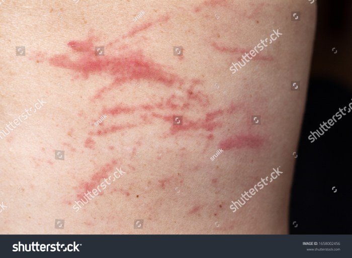 Skin sore or abrasion produced by scratching or scraping